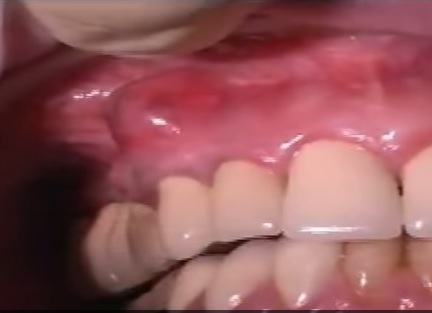 What Is A Tooth Abscess Updated Tooth Pain And Infections
