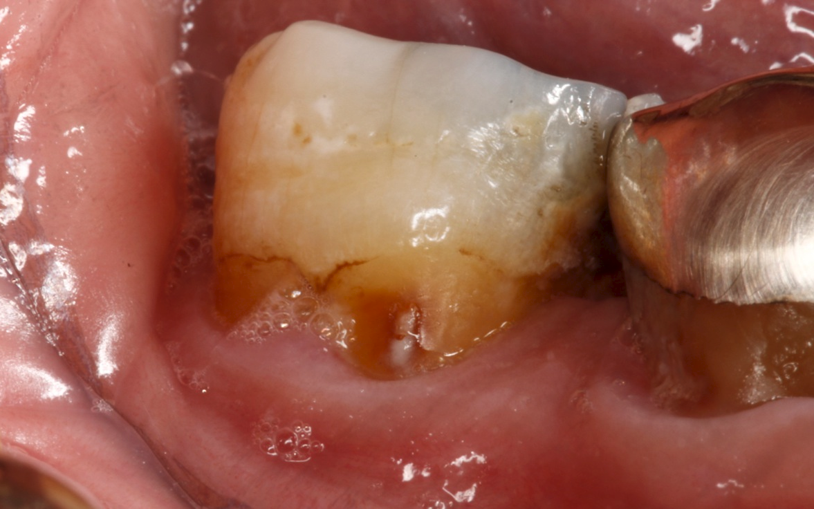 Tooth Decay on the Root Surface | MCCarl Dental Group