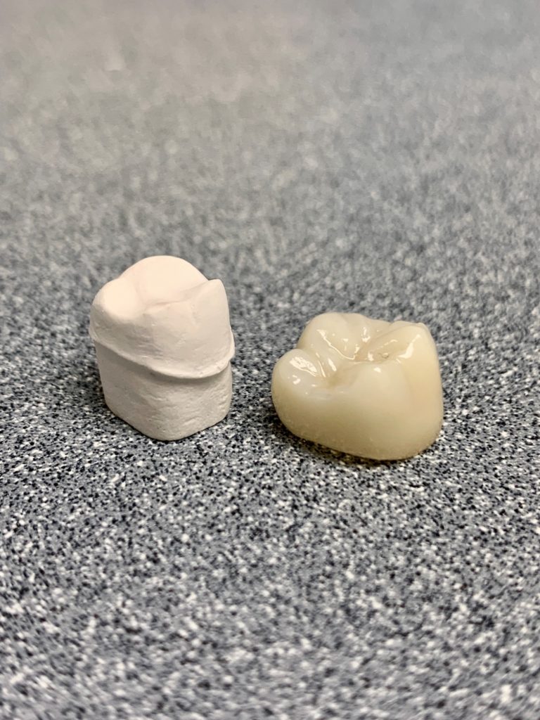 a broken dental crown